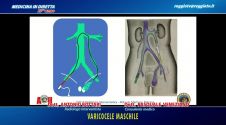 Il Varicocele maschile