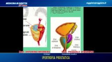 L'ipertrofia prostatica