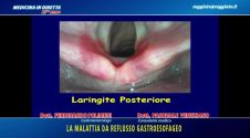 La malattia da reflusso gastroesofageo