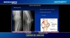 L'artrosi del ginocchio
